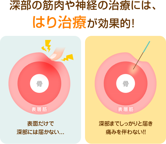 入間市　深部の筋肉や神経の不調には、はり施術が効果的！