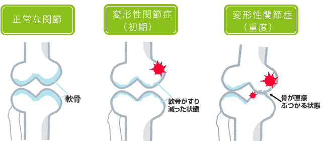 膝が痛くなる段階のイメージ